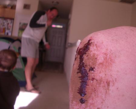 a mtn biking incident...
